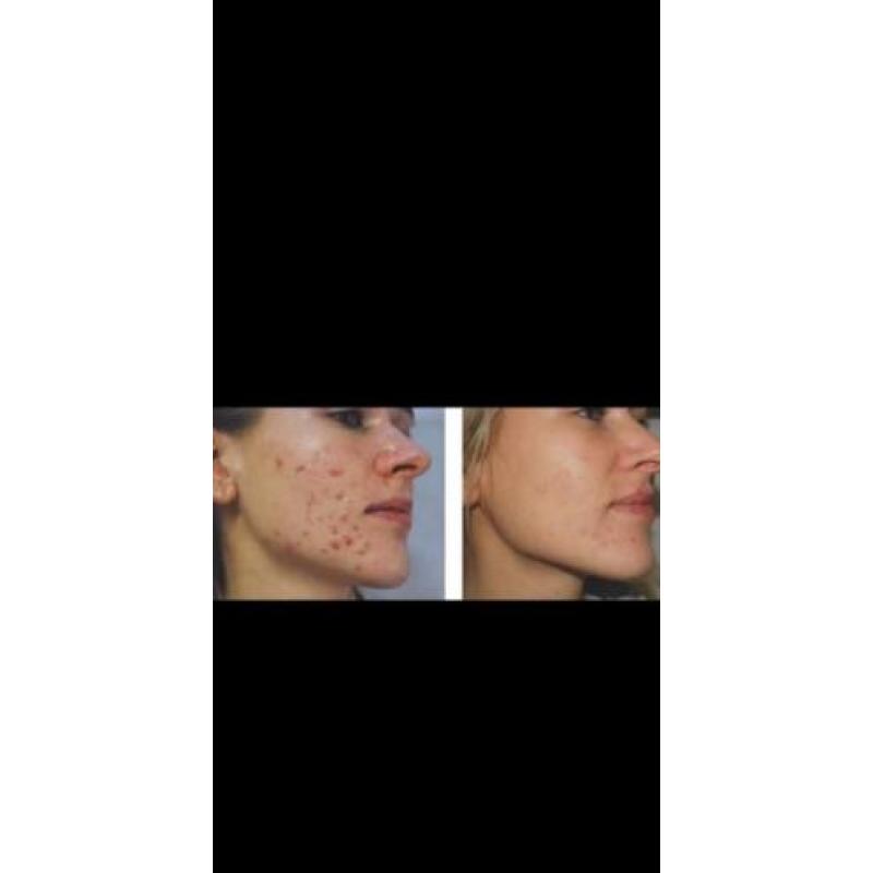 Acne model gezocht, GRATIS!!!